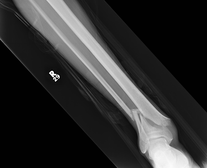 An x-ray of my broken leg